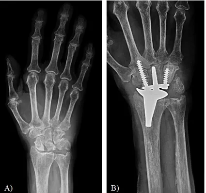 Figure 1.20: Distal Radioulnar Joint Arthritis. A radiographic of a patient presenting with osteoarthritis 