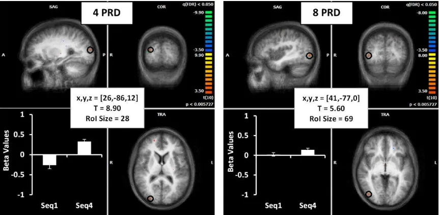 Figure 4. Brain images show location of activation (from seq 2-3) in red (highlighted with a 