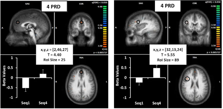 Figure 8.  The brain image shows the average activation location for the 4PRD task (in red 