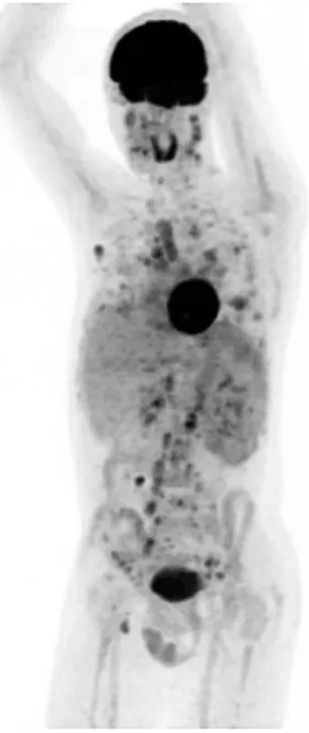 Figure 3 FDG-PET, maximum intensity projection. 
