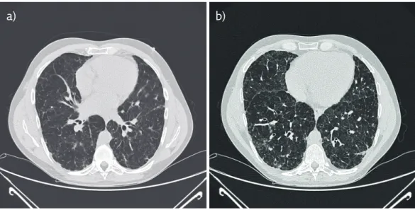 Figure 5  a) High-resolution computed tomography in inspiration during follow-up (interval: 9-years)