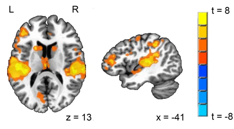 Figure 3.1. Regions showing differences between L1 English and L2 Mandarin, at a statistical threshold of t = 2.80, p = .01