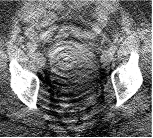 Figure 1-1: Ring artefact in a pelvic CT. Image was adapted from Boas et al. (2012).5  