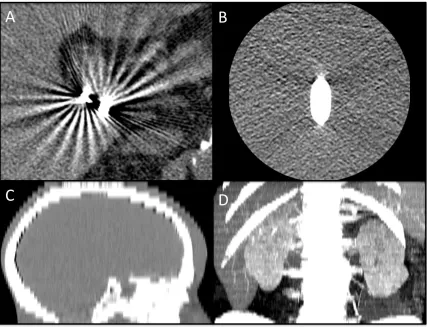 Figure 1-2: Reconstruction-based artefacts. A) Windmill artefact streaks around cholecystectomy clips