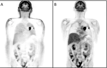 Figure 1-15: A comparison of two reconstructions of the same PET data.  A) Image 