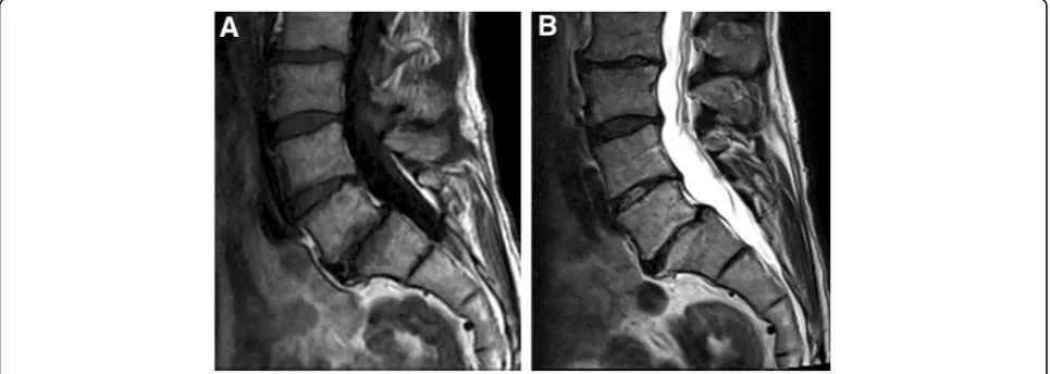 Fig. 3 Follow-up scans of the same female than in Fig. 2 using 1.5 T scanner. a T1- and b T2- weighted images show M2 at L4/5 level
