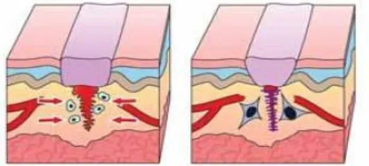 Fig 1: Phases of Wound Healing 