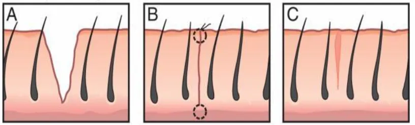 Fig 2: Types of Wound Healing 