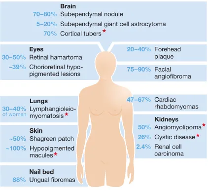 Figure 1-1: The multisystem pathogenesis of tuberous sclerosis complex. A range 