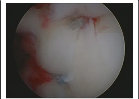 Fig. 2 Inserting the metal screw anchor
