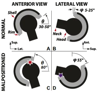 Figure 1-7 - A and B show an acetabular component with normal abduction and anteversion angle respectively