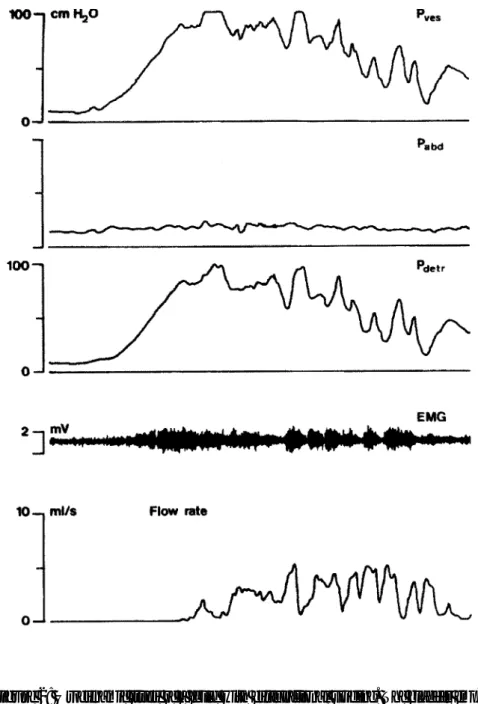 Figure 2: Urodynamic study of a child with dysfunctional voiding. The bladder emp- emp-ties on a sustained detrusor contraction that is countered by the pelvic floor