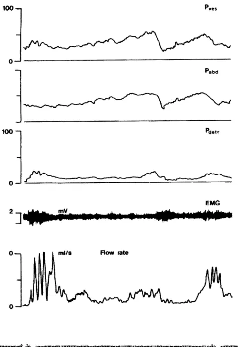 Figure 3: Urodynamic study of a child with a lazy bladder syndrome. Note the absence of detrusor contraction