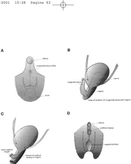 Figure 1: A. skin incisions are made according to the dotted lines. B. urogenital sinus and vagina are incised according to dotted lines after inserting a small caliber balloon catheter into the vagina endoscopically