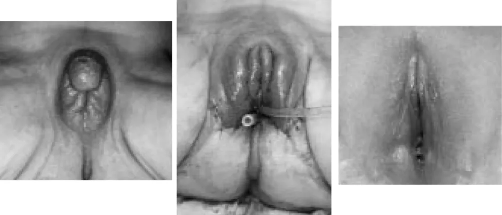 Figure 4: A. pre-operative photograph of a patient with adrenogenital syndrome and high ending vagina