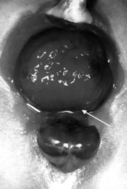 Figure 1: Example of a new-born boy with bladder extrophy. The child has a rela- rela-tively large bladder plate, a good candidate for successfull development of the bladder after primary closure