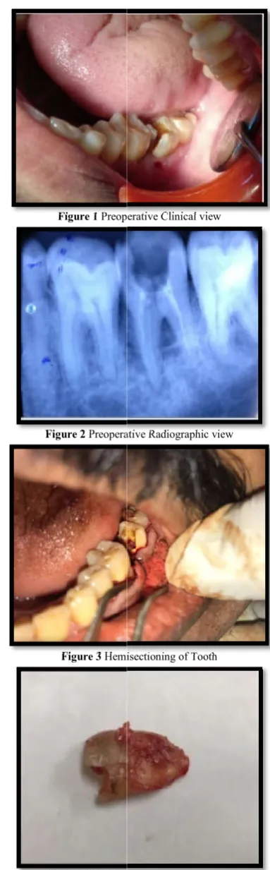 Figure 1 Preoperative Clinical viewPreoperative Clinical view 