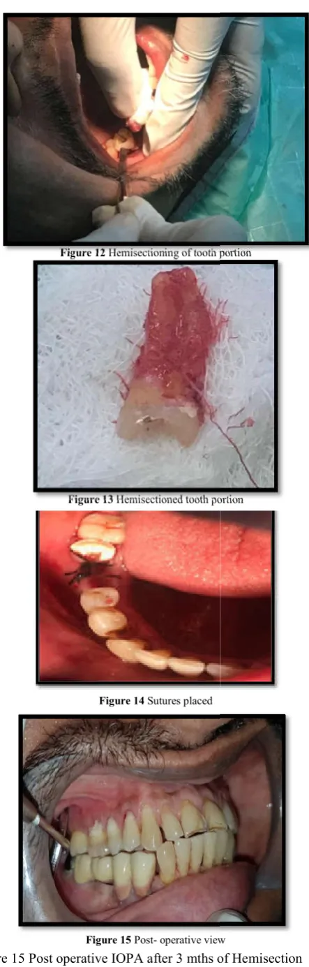 Figure 15 Post operative IOPA after 3 mths of Hemisection prior to prosthetic rehabilitation  mths of Hemisection  