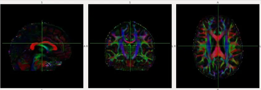 Figure 2: Principal eigenvector colour map (from pilot participant in Study III). Leftmost panel: sagittal view; Middle panel: Coronal view; Rightmost panel: axial view