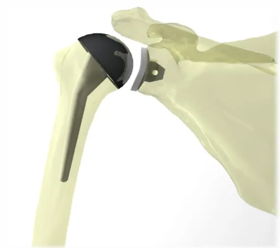 Figure 1.4: Total Shoulder Arthroplasty 