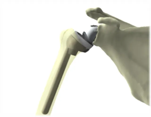 Figure 1.5: Reverse Shoulder Arthroplasty 