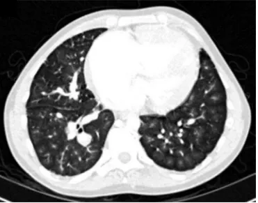 Figure 2: Selected image from a patient with idiopathic pulmonary arterial hypertension showing centrilobular ground glass opacities
