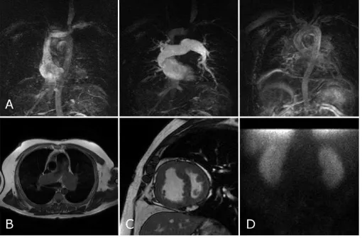 Figure 4: Selected images from a patient with PH due to a patent foramen ovale. The top row (A) shows the images from the time resolved TRICKs, with increasing time to the right of the image