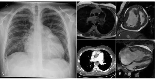 Figure 5: Images from a patient with IPAH. The chest radiograph shows cardiomegaly with dilatation of the pulmonary artery, the patient has a PICC for intravenous delivery 