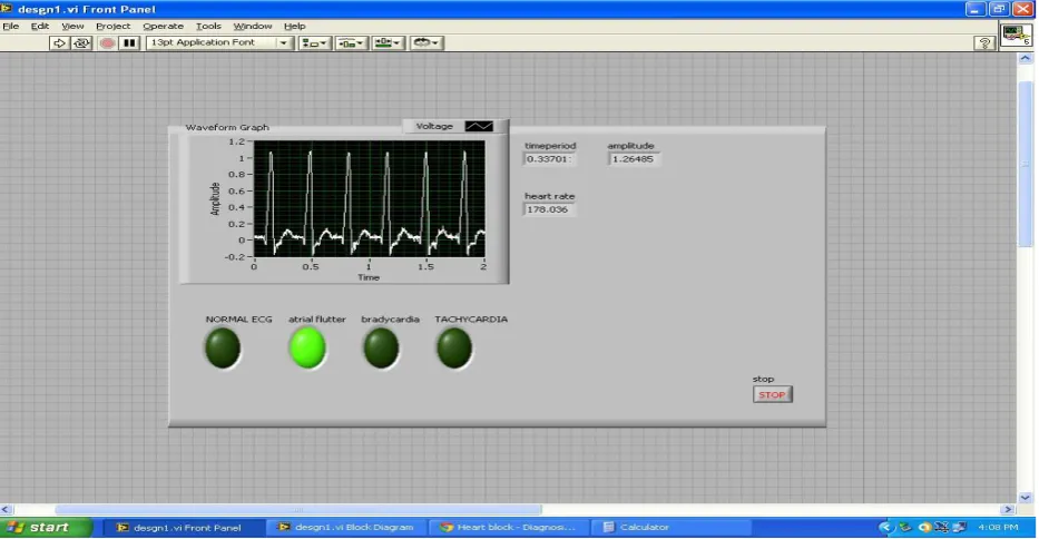 Figure 6 : VI used to detect atrial flutter, Bradycardia and Tachychardia 