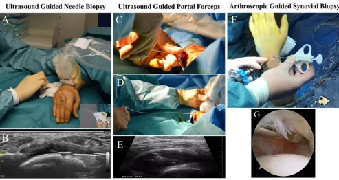 Figure 1 (A) The ultrasound-guided needle biopsy (US-NB) procedure of wrist, in outpatient clinic using local anaesthesia