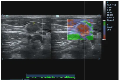 Figure 14  HPE proved micropapillary CA showing necrotic (central anechoic areas) level III cervical LN with ES 5 (peripheral hard areas with central soft areas suggestive of central  HPE proved micropapillary CA showing necrotic (central anechoic areas) level III cervical LN with ES 5 (peripheral hard areas with central soft areas suggestive of central necrosis) and SI 1.79 