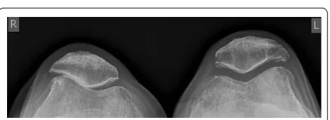 Figure 1 Preoperative radiographs of the knees. Tibiofemoralaccentuated gonarthritis at the left side.