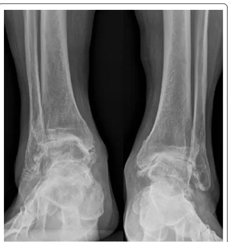 Figure 4 Preoperative lateral views of the ankles. Concentricend-stage ankle osteoarthritis on both sides.