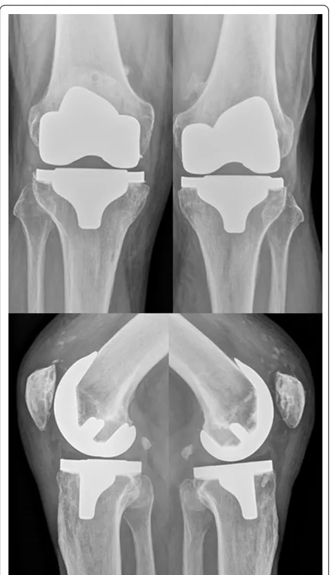 Figure 8 Radiographs ap and lateral of the knees 25 monthsafter surgery. The picture shows correctly implanted bilateral TKAs.
