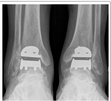 Figure 11 Lateral radiographs of both ankles 25 months afterTAA. TAA centered correctly under the tibial axis.