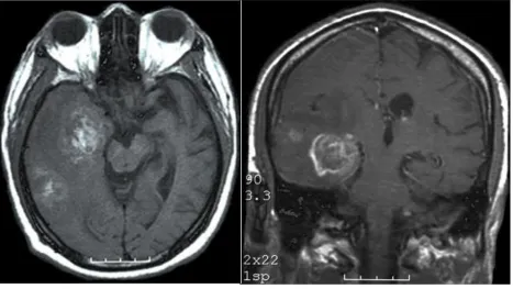 Fig 2 Glioblastoma multiforme 