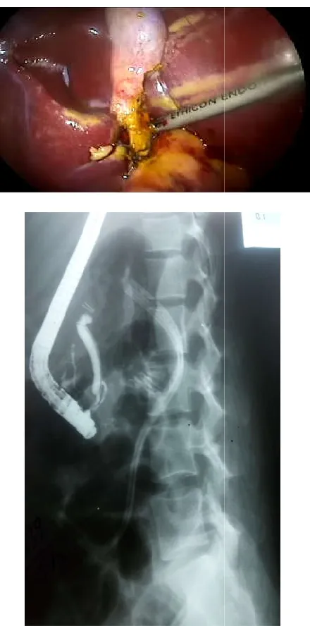 Fig. ERCP showing distal part of CBD with clips on Fig. ERCP showing distal part of CBD with clips on 