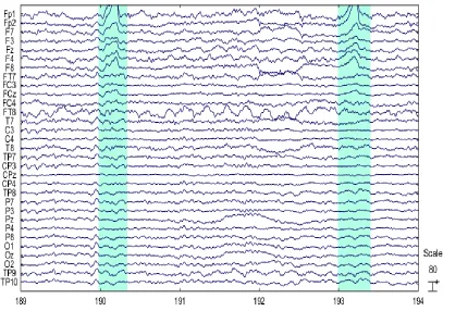 Figure 1.10. Eye blinking artifacts represented by the highlighted areas in 190 and 193 seconds