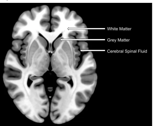 Figure 1.1: Axial brain slice of a control brain with labeled fea- fea-tures. Note the image is in neurological format (right side of brain on right), with the frontal lobe facing up.
