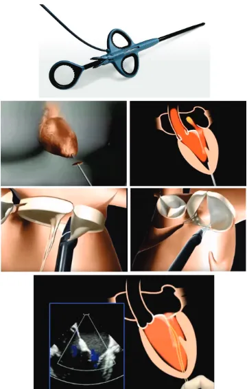 Figure 1.5: Minimally invasive oﬀ-pump MV repair based on NeoChord DS1000 device.†Adapted from NeoChord (www.NeoChord.com)