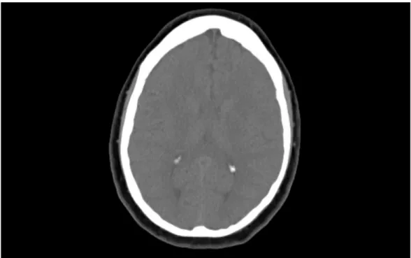 FIGURE 1: CT head without contrast