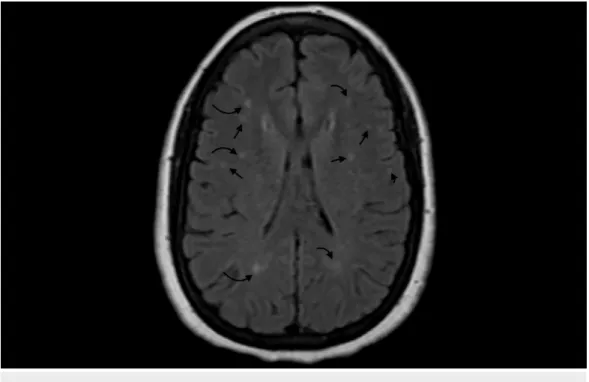 FIGURE 2: MRI of the brain
