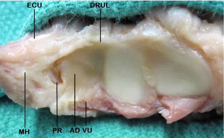 Figure 1.2: The Triangular Fibrocartilage Complex.  AD = Articular Disc, PR = Prestyloid Recess, VU = Volar Ulnocarpal Ligaments (includes ulnolunate, ulnocapitate and ulnotriquetral ligaments) arising off the Volar Radioulnar Ligament (deep and not shown), DRUL = Dorsal Radioulnar Ligament, MH = Meniscus Homologue, ECU = Extensor Carpi Ulnaris (© B Gammon) 