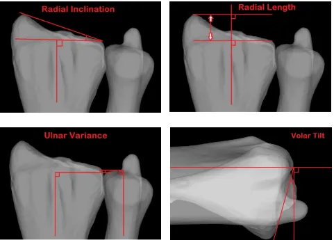 Figure 1.16: Measurement parameters for the distal radial articular surface, including radial inclination, length, ulnar variance and volar tilt (© B Gammon)