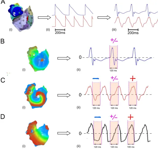 Fig 2. Illustration of different atrial activation associated with different body surface atrial waveform morphology