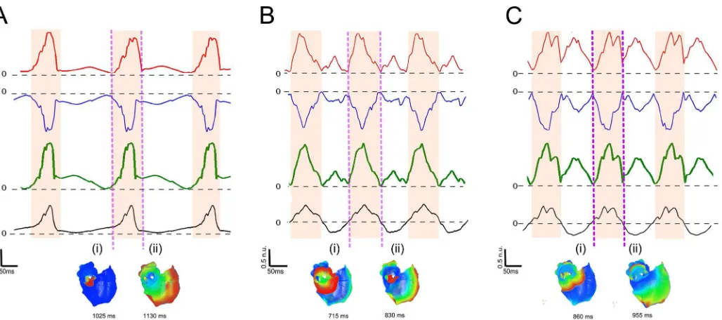 Fig 3. Dipole and atrial activation evolution in different atrial activations located in the pulmonary veins (PV)