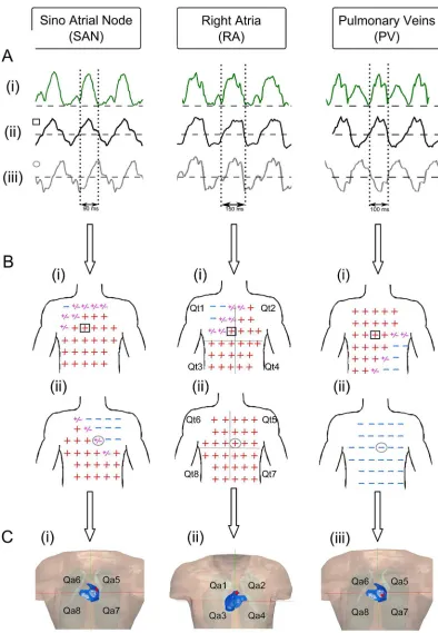 Fig 4. Illustration of the correlation used by the algorithm for activation from three atrial sites