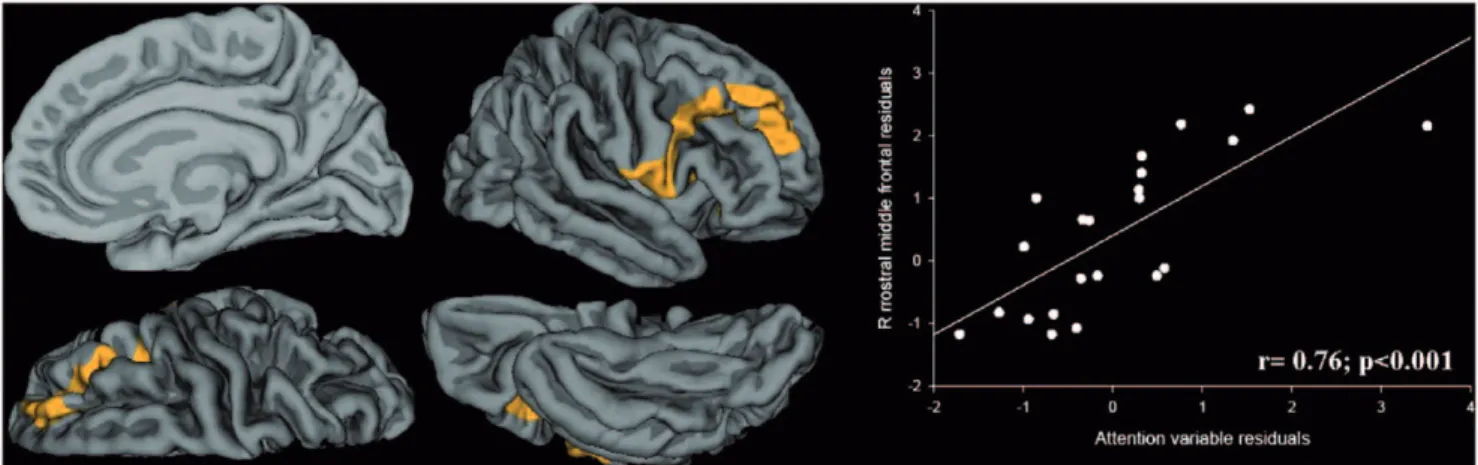 Figure 3. Map of correlation between attention subscale and CTh in PVL children. The colour bar represents statistically significant (P,.05) thinning (blue) or thickening (yellow)