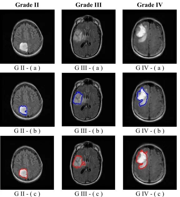 Figure 1: Examples of Grade II, III, and IV brain oedemas: a) original MRI slice, b)  superpixel segmentation, c) manual segmentation