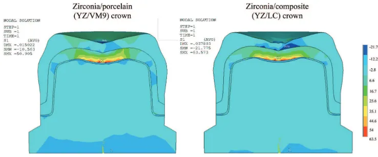 Fig. 3 Cross sectional view of stress (MPa) distribution of the zirconia/composite and the 